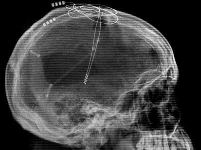 Diepe hersenstimulatie